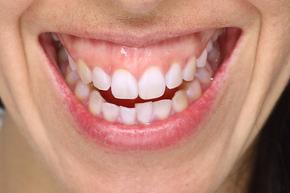 Gummy Smile Treatment Vacaville