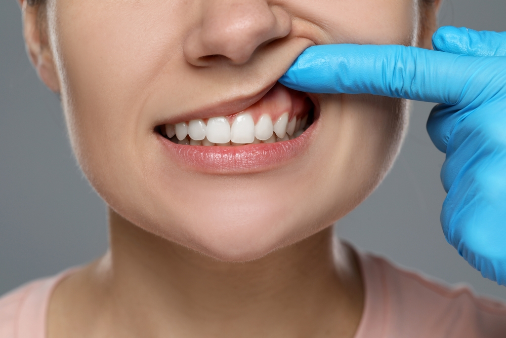 Gum Grafts Vacaville