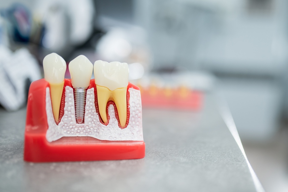Dental Implants Vacaville